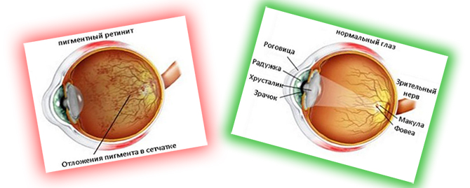 Пятно в глазу в поле зрения. Зрение при пигментном ретините. Пигментный ретинит как видят. Как видит человек с пигментным ретинитом. Пигментный ретинит рекомендации для дете.