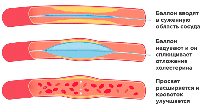 Ангиопластика сосудов нижних. Баллонная ангиопластика артерий нижних конечностей. Баллонная ангиопластика коронарных артерий техника. Баллонная вазодилатация (ангиопластика периферических артерий). ТРАНСЛЮМИНАЛЬНАЯ баллонная ангиопластика нижних конечностей.
