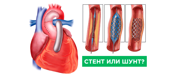 Что такое шунтирование сердца и сосудов. Аортокоронарное шунтирование операция. Шунтирование сосудов сердца стент. Что такое шунтирование сосудов сердца и стентирование. Стентирование и аортокоронарное шунтирование.