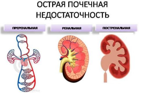 Что такое почечная недостаточность, как проявляется и лечится?