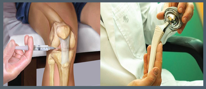 Операция по замене коленного сустава москва