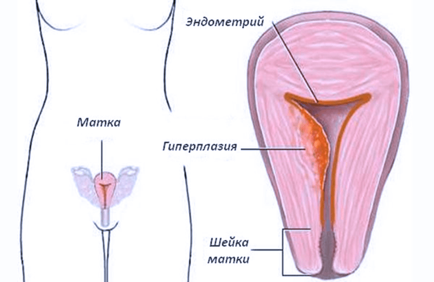 Женские эндометрии. Гиперплазия эндометрия. Гиперплазия эндометрия матки что это. Эндометрит матки и гиперплазия эндометрия. Гиперплазия миометрия.